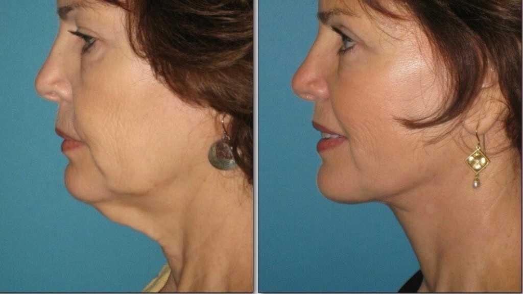 Necklift