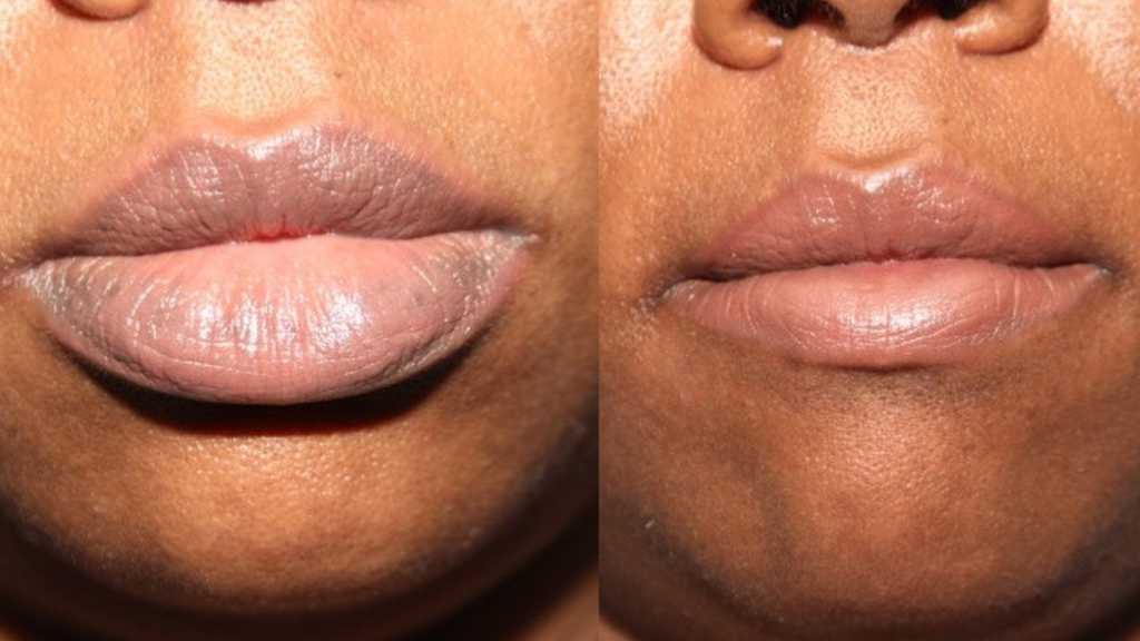 Lip Reduction