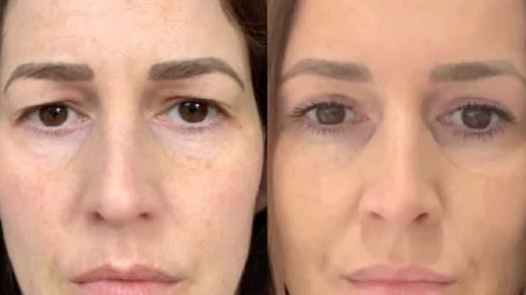 Bleparoplasty Upper
