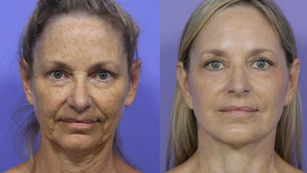 Facelift