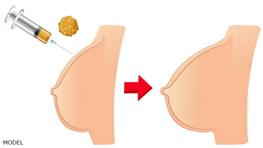 Breast Augmentation with Implan or Fat Transfer