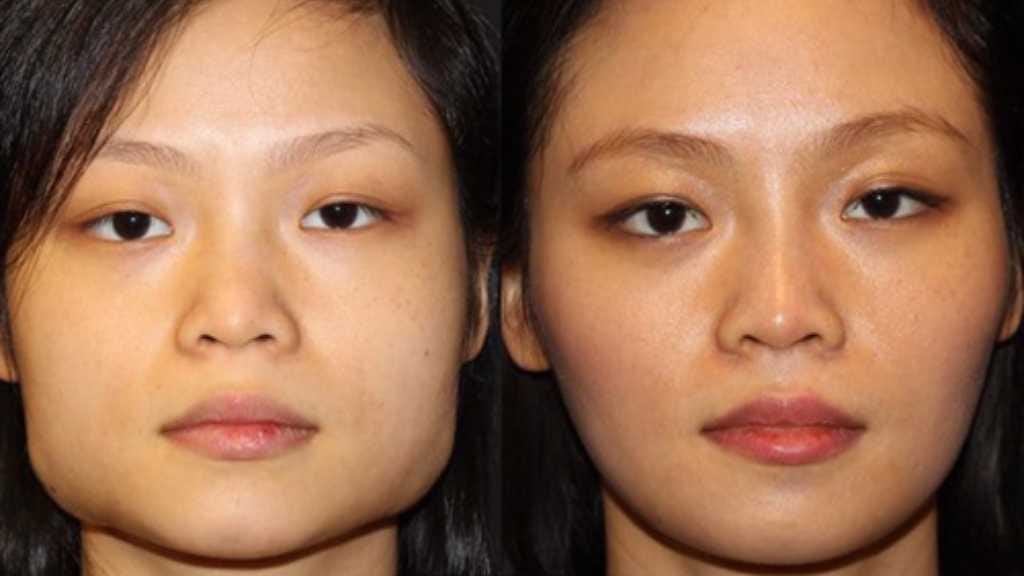 Jaw Bone Reduction
