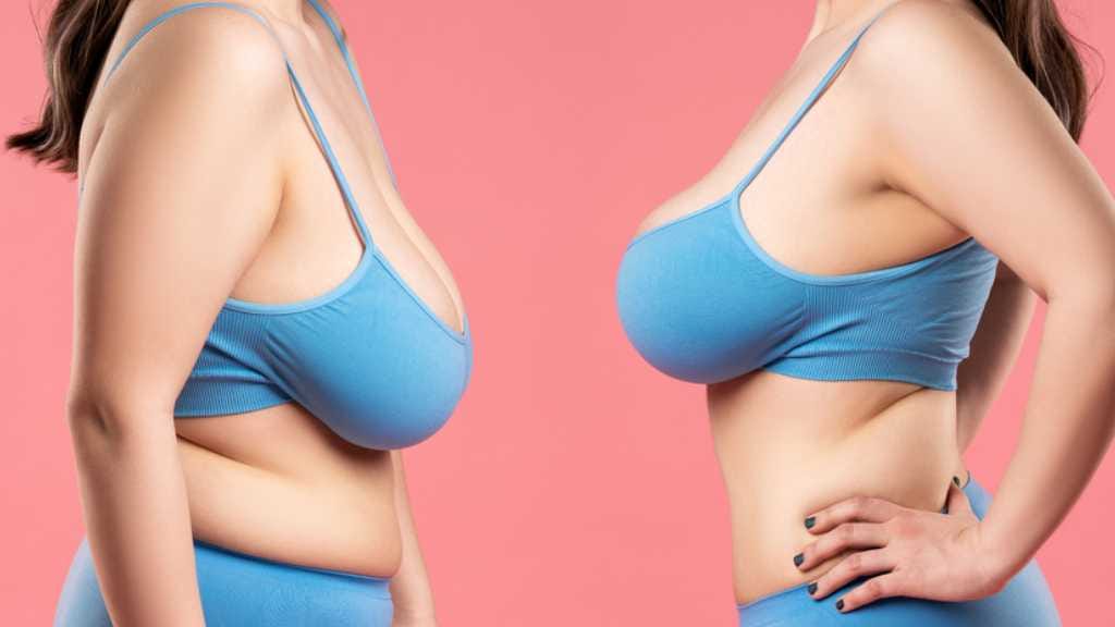 Breast Reduction