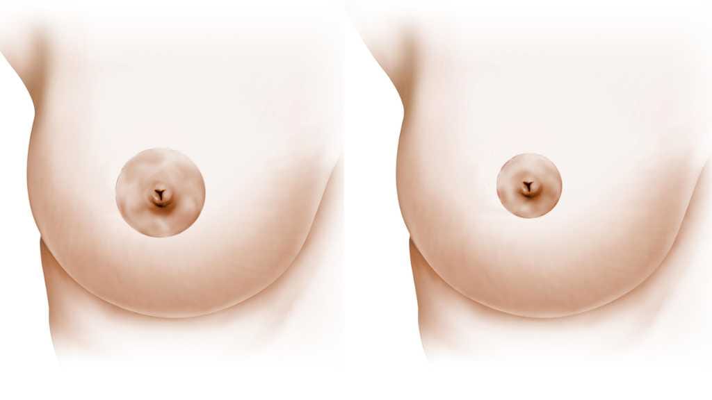 Areola Reduction