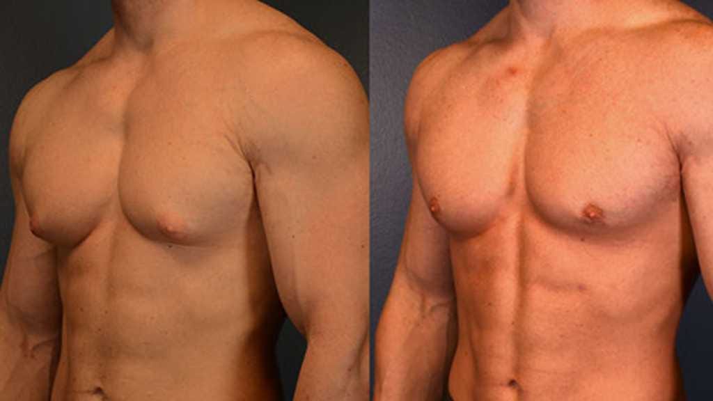 Gynecomastia Reduction
