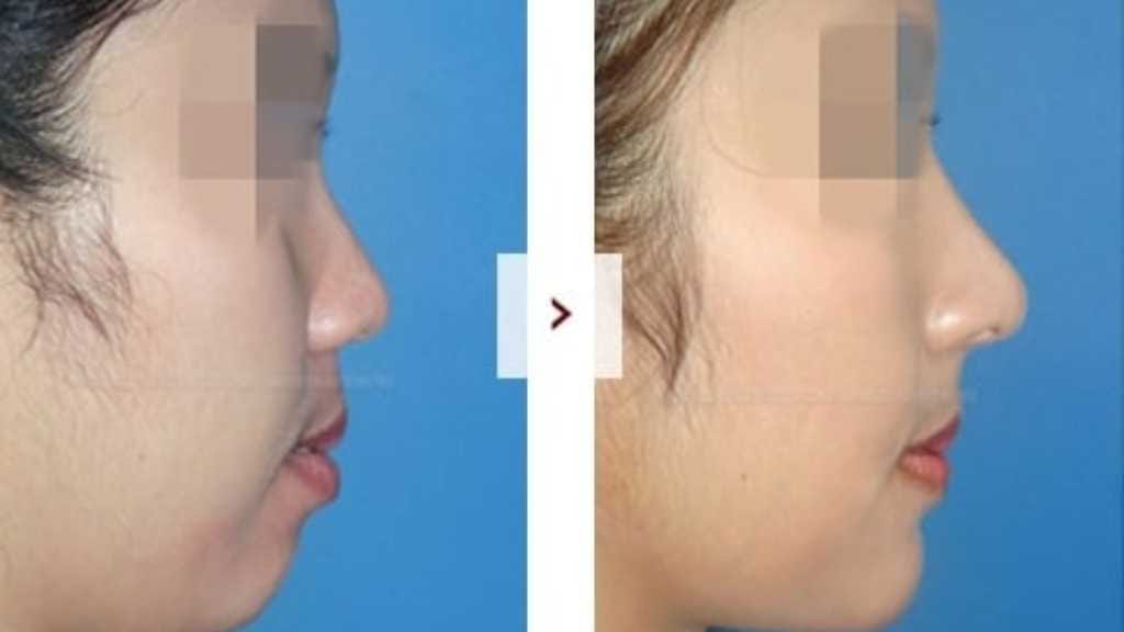 Rhinoplasty dengan implan/ear cartilage/iga