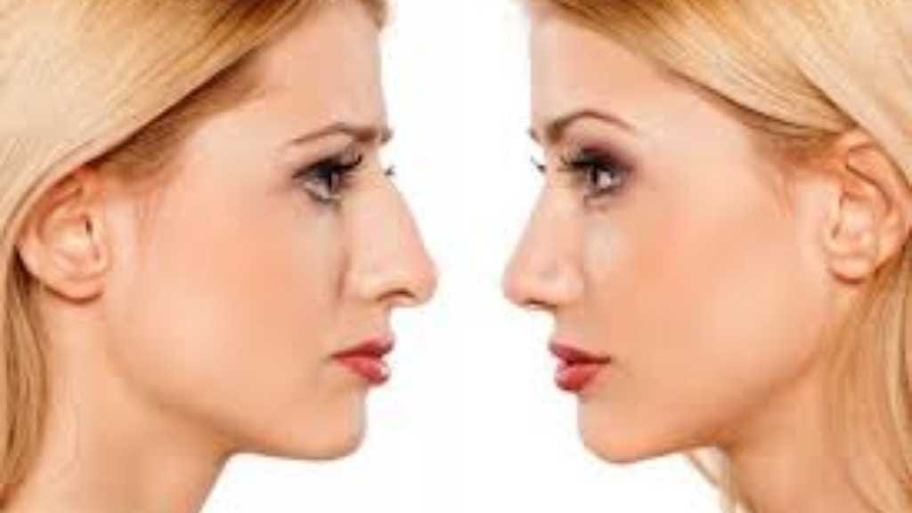 Tip Plasty
